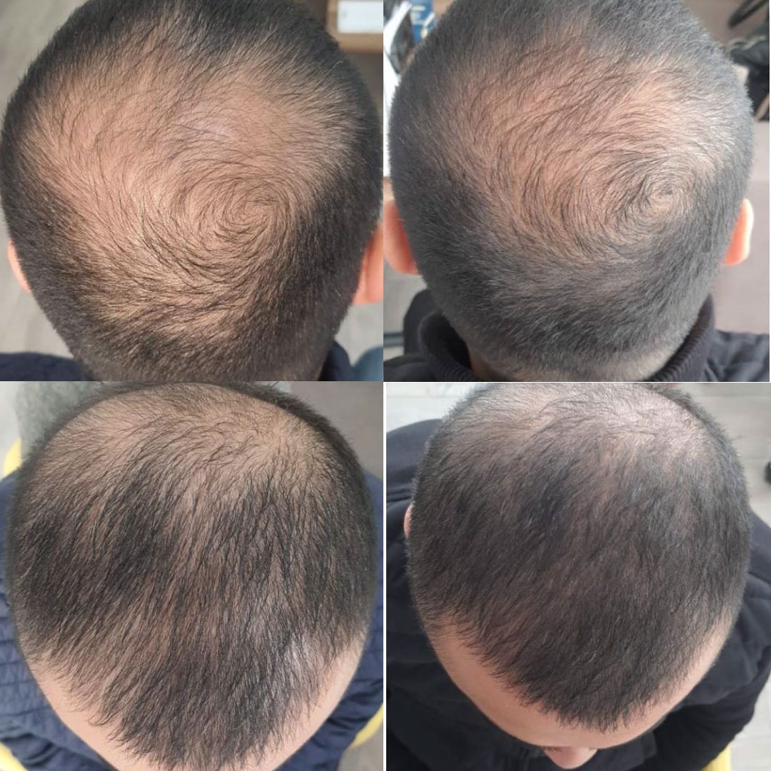 PRP-Behandlung Haarausfall Mannheim PRP-Behandlung Haarausfall Mannheim